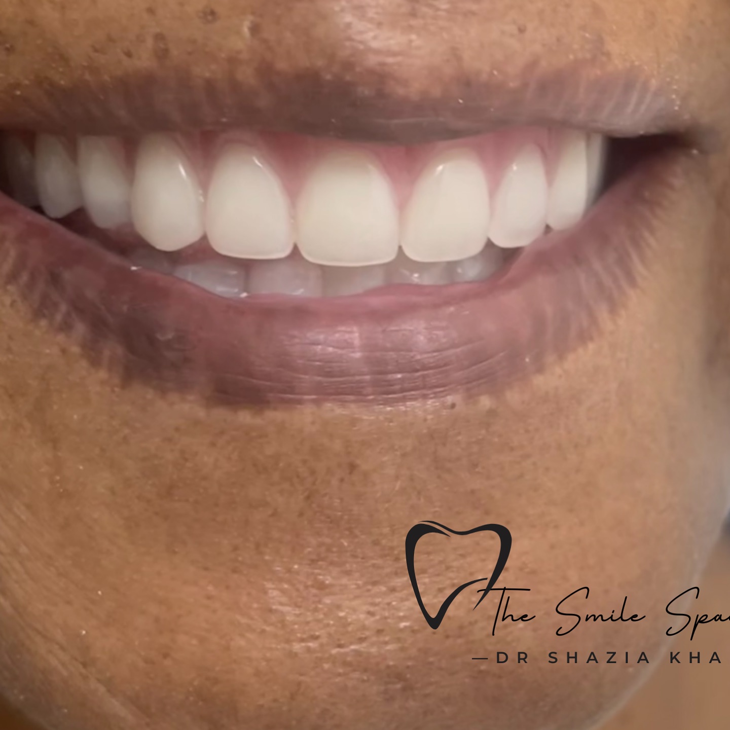 Cosmetic veneers smile transformation by Dr Shazia Khan