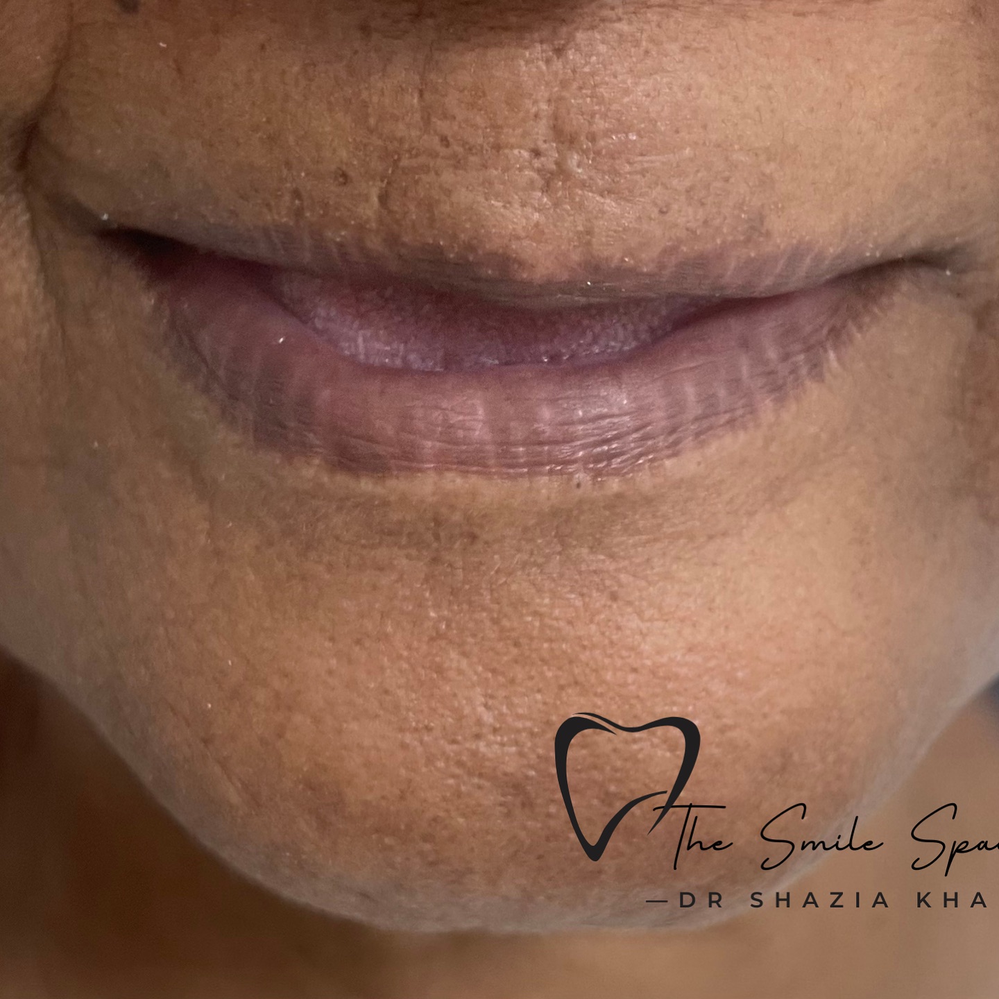 Patient smile before veneers treatment