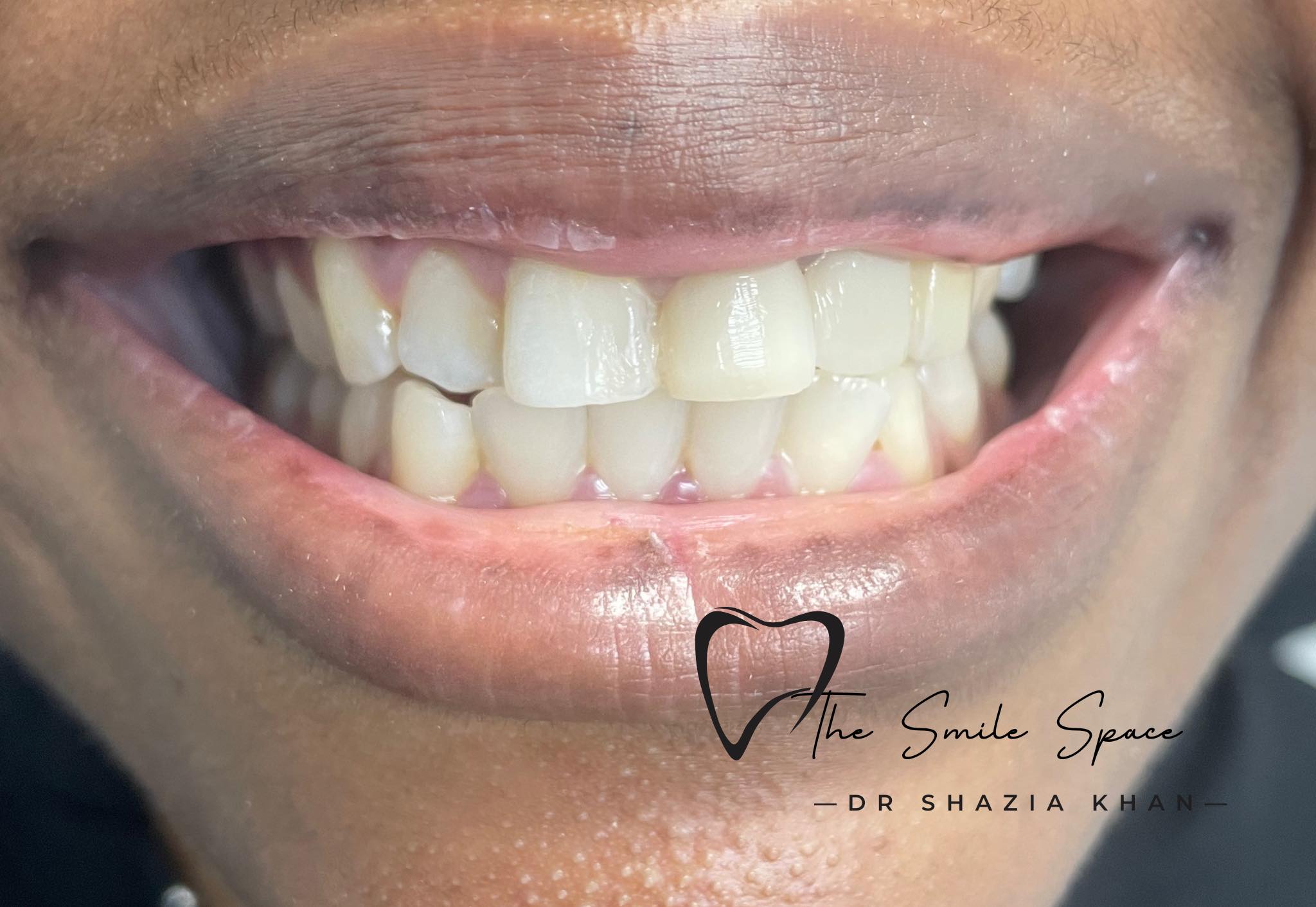 Patient smile after full smile reconstruction by Dr Shazia Khan