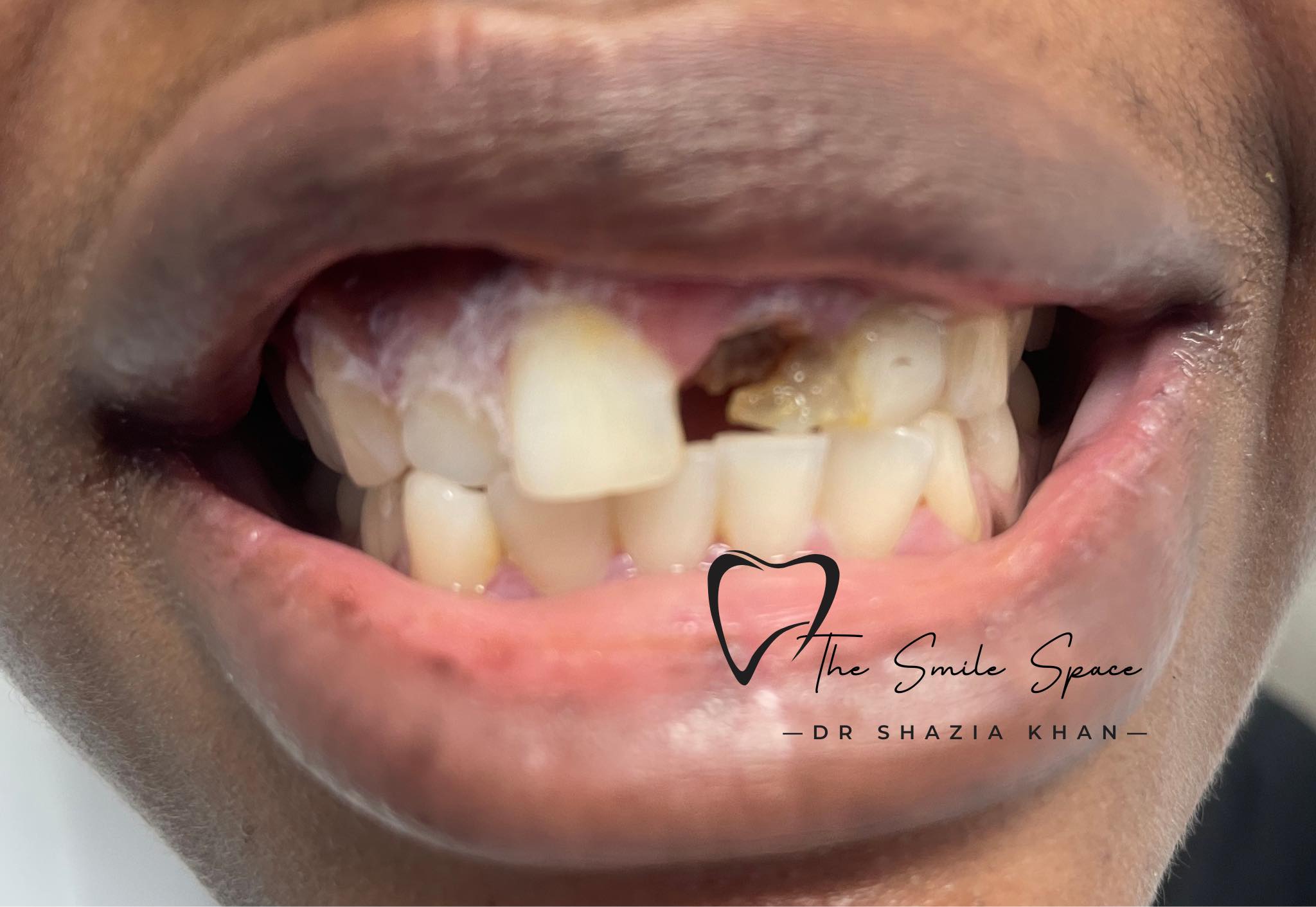 Patient smile before full smile reconstruction