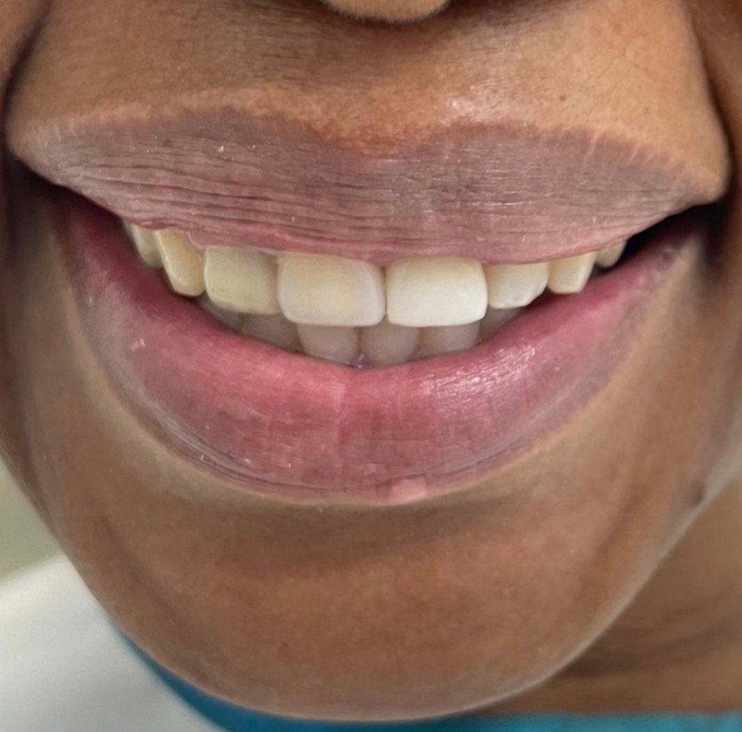 Full smile makeover restoration result
