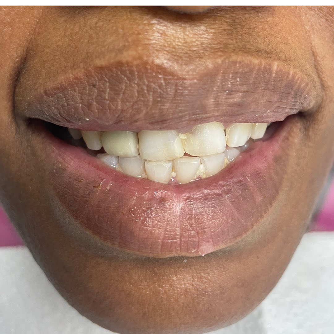 Patient smile before orthodontic alignment